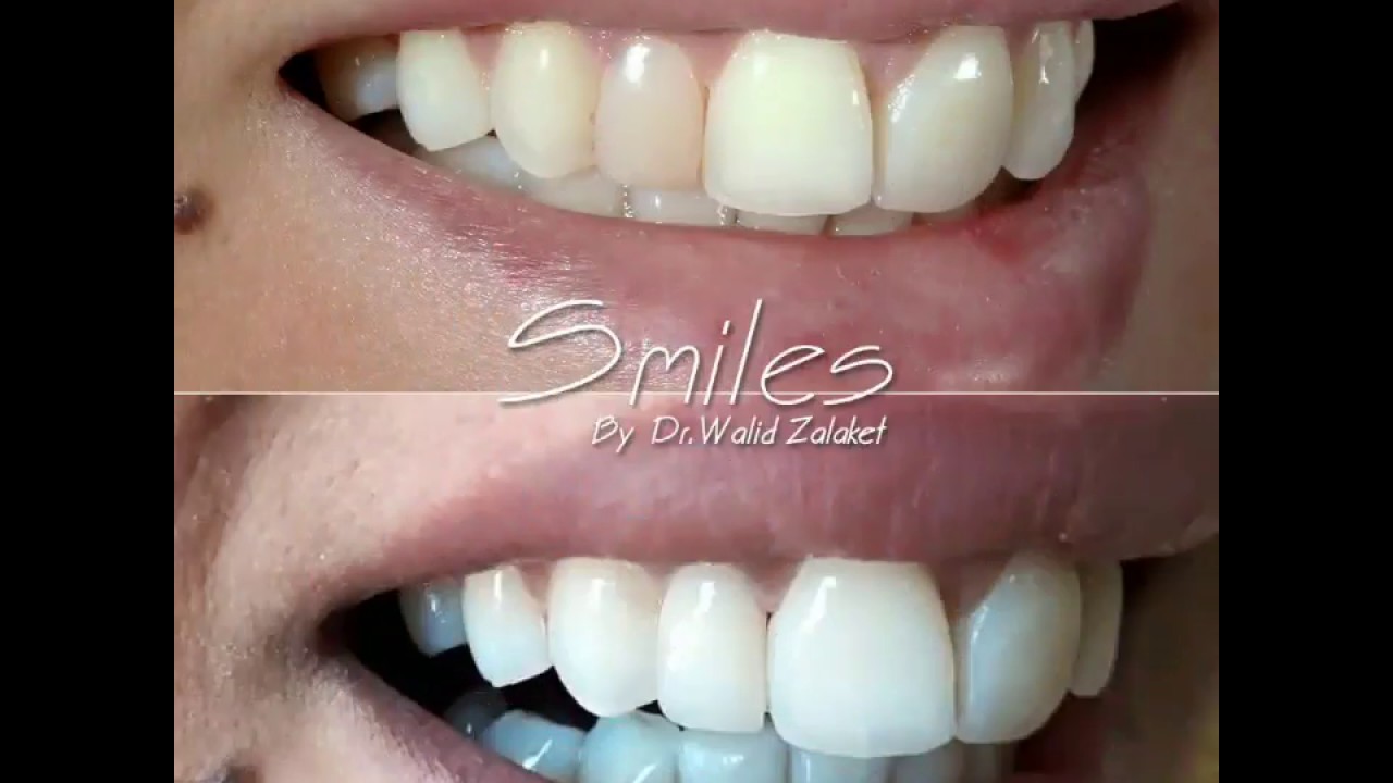 Composite Veneers Vs Porcelain Veneers By Dr Walid Zalaket Youtube