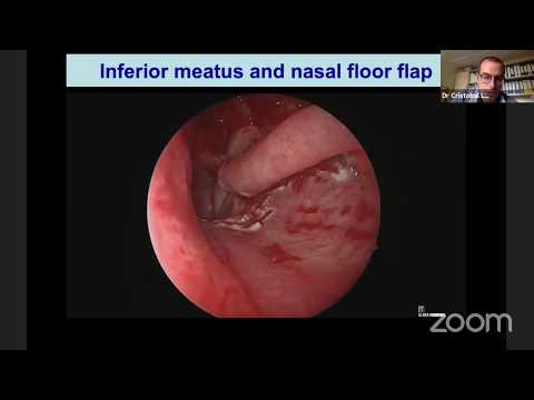 Video: Septum Perforasi: Gejala, Pengobatan, Pemulihan, Outlook, Dan Lainnya