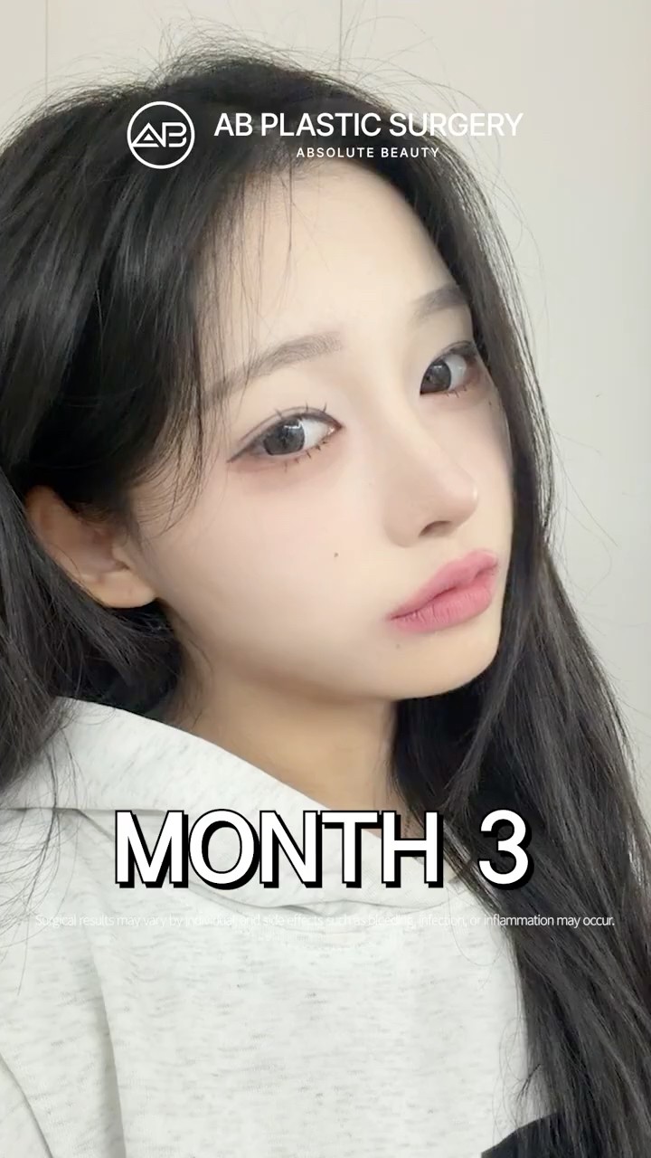 Ptosis Correction & Rhinoplasty Glow-Up ✨ #Shorts