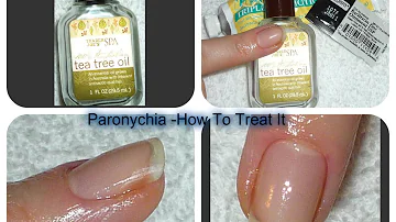 How is chronic paronychia treated?