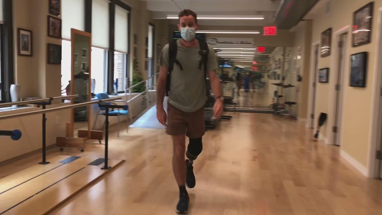 Below the Knee Prosthesis made in ONE DAY!