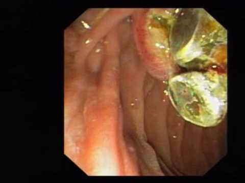 Safra kanalındaki taşların endoskopik olarak çıkartılması (ERCP)