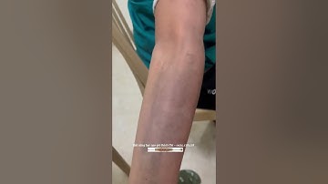 Giải pháp tự nhiên hiệu quả cho đau cổ vai gáy Cạo gió sừng bạc Bách Chi