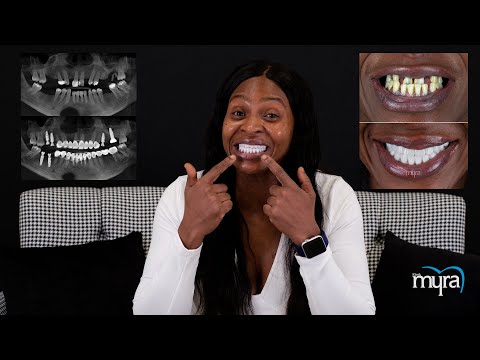 Amazing Smile Makeover 2021 [Full Mouth Dental Implants | Veneers]