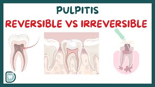 Reversible Pulpitis Vs Irreversible Pulpitis: Symptoms, Diagnosis, Testing, and Management