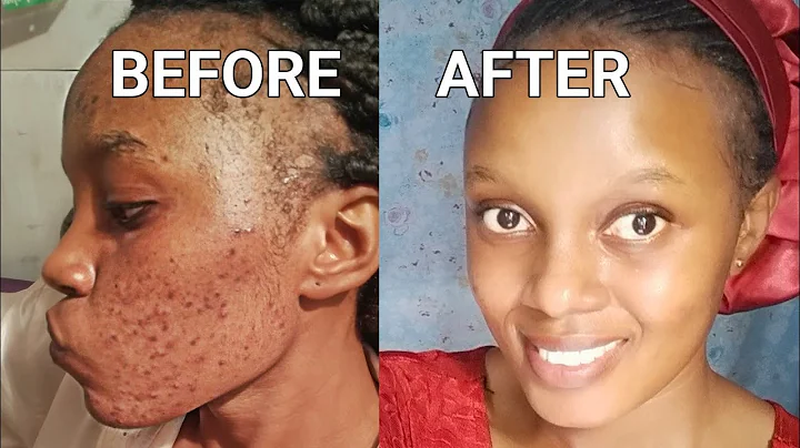 MY ACNE JOURNEY//HOW I TRANSFORMED MY SKIN WITH TH...