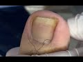 Severely squeezed nail