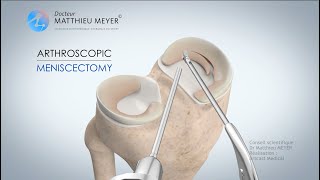 ARTHROSCOPIC MENISCECTOMY - DR MATTHIEU MEYER - PARIS, FRANCE