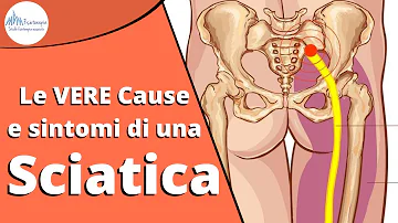 Cosa si può fare per alleviare il dolore del nervo sciatico?