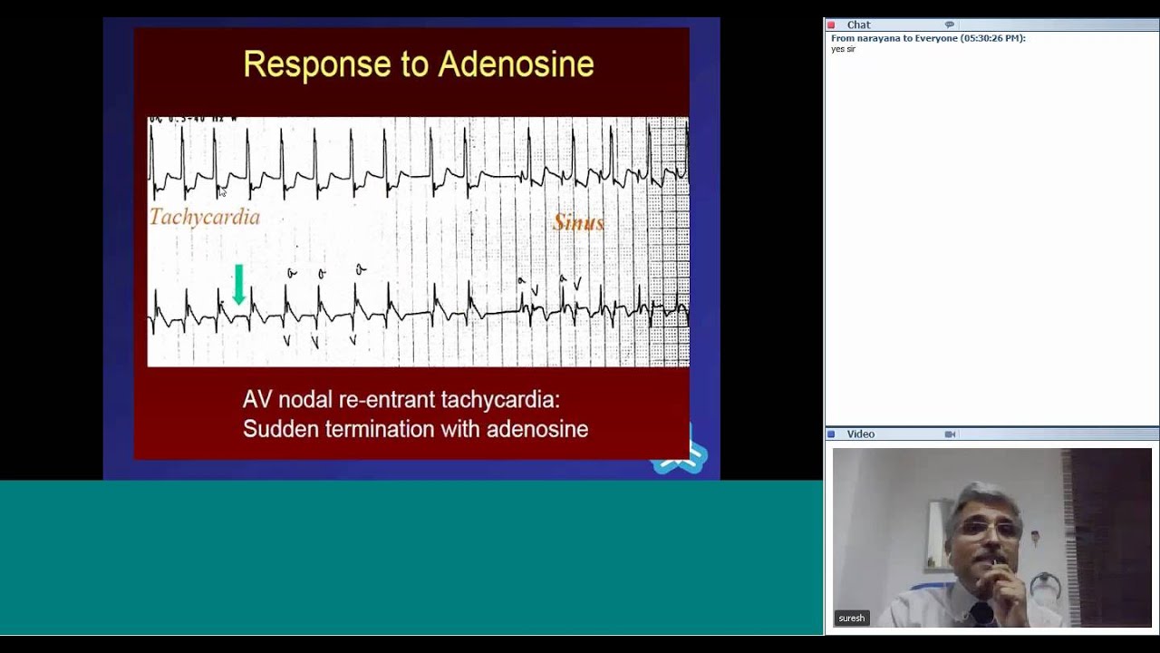 Tachyarrhythmias in Children by Dr Suresh Kumar
