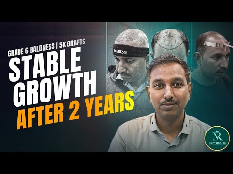 Life-Changing Hair Result 😍 | Hair Transplant in Nagpur | Real Cost & Results | New Roots