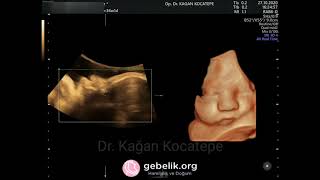 34 haftalık (8 aylık) gebelikte bebeğin 4d ultrason görüntüleri ve mimikler - Dr. Kağan Kocatepe Resimi