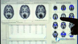 MindGenesis Alzheimer's Disease Early Detection Diagnostic in Littleton, Colorado