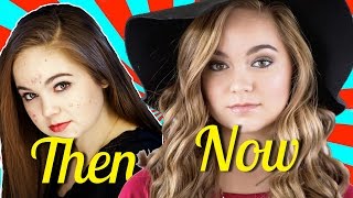 I FINALLY Cleared My Acne!