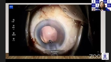 AIOS ARC - Cataract Surgery in Complexities - A Learning-Dr.Sheetal Brar