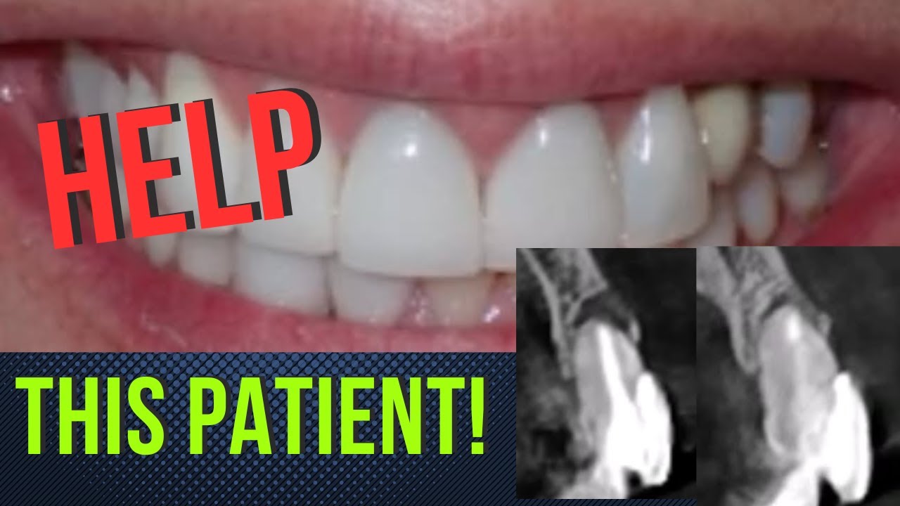 Preserve Teeth: Harnessing Patient's Healing Ability - YouTube