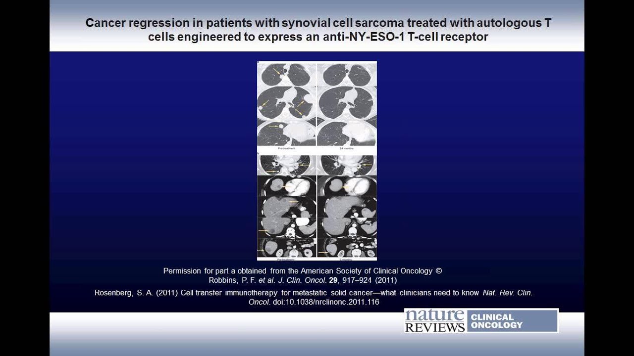 Adoptive Cell Therapy for Cancer