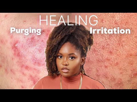 PURGING OR IRRITATION? | Esthetician Explains How to Identify and Treat Both Conditions