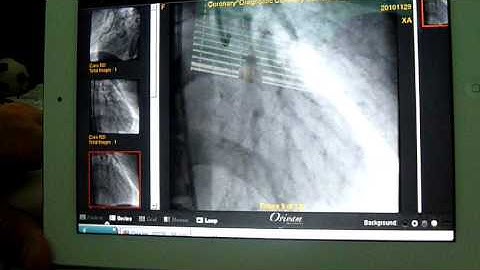 Oracle VDI on Ipad - Demo Coronary Catherization