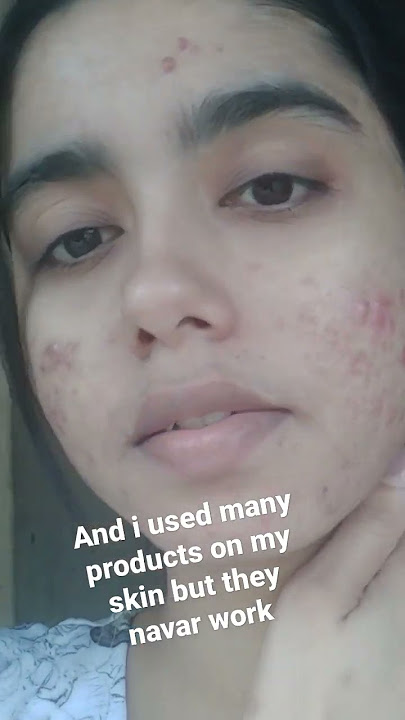 minimalist niacinamide zine serum for ance pro skin#shorts #shortsindia #youtubeshorts #skincare