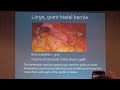 05 MIS for Benign Disease Management of Hiatal Hernia