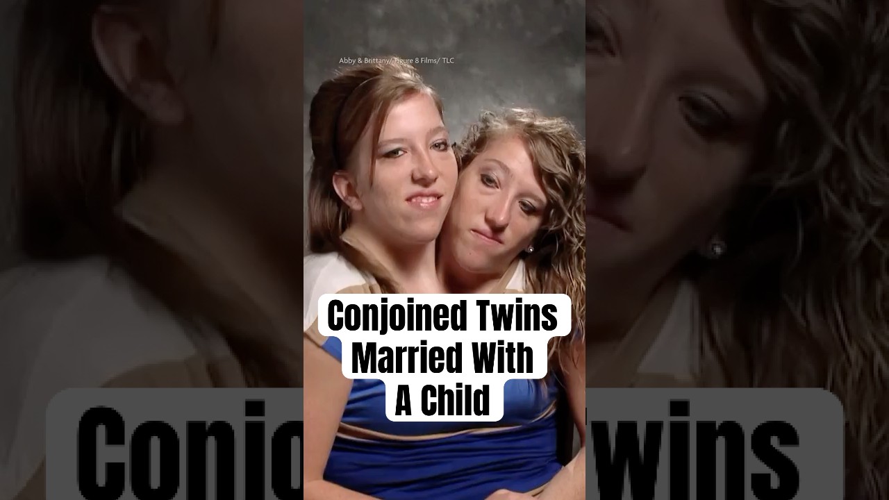 Conjoined Twins Married With A Child? 