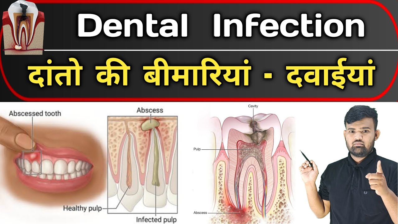 दांतो का संक्रमण | Dental Infection | Medicine | Medicine knowledge | Doctor | Dentist | Nursing