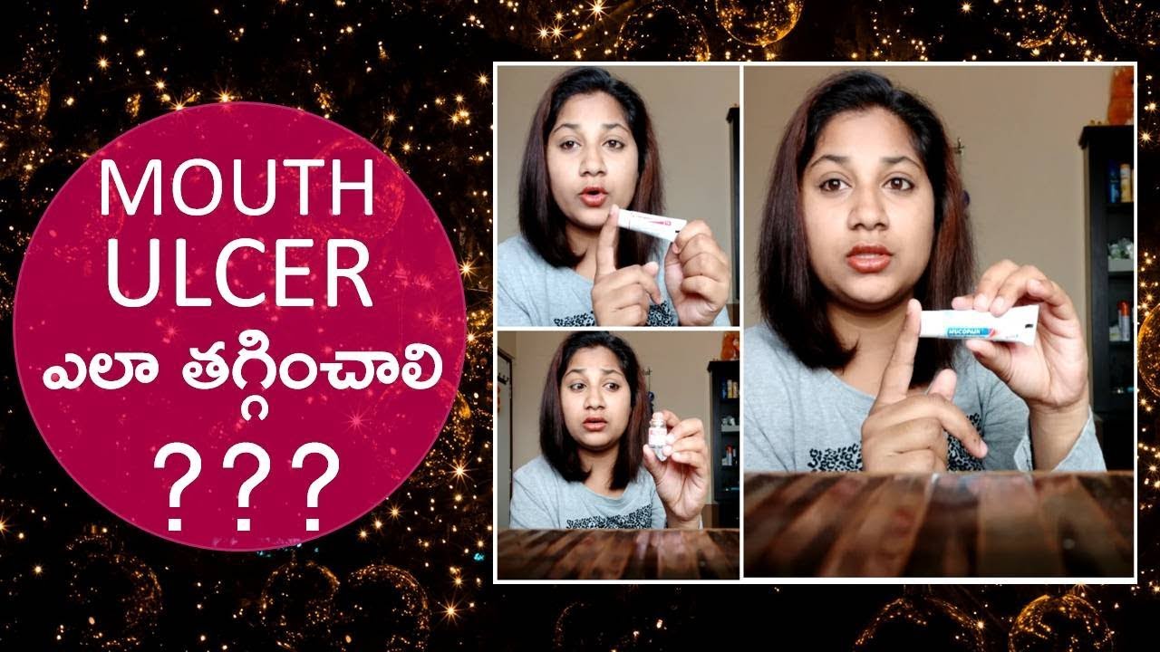 how-to-remove-mouth-ulcers-home-remedies-to-get-rid-of-canker-sores