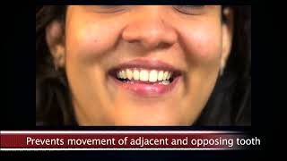 CROWN aND BRIDGES  #dental #shahabadmarkanda #care #prp #daj  #dentalcare PATIENT EDUCATION VIDEO