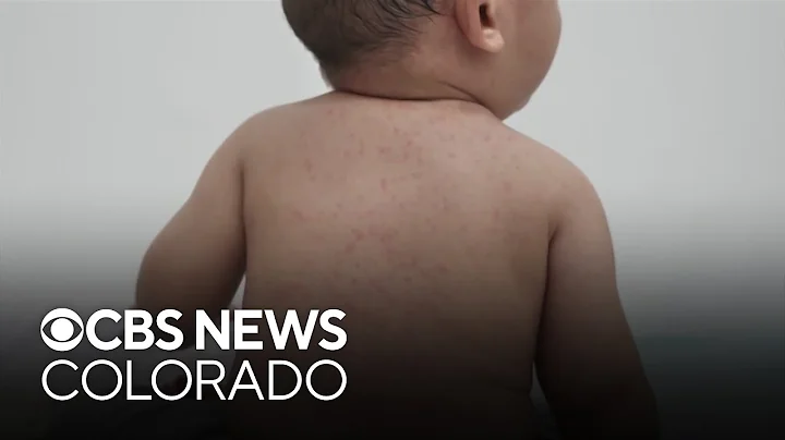 As Colorado measles cases grow, doctors share who does, and doesn't, need boosters