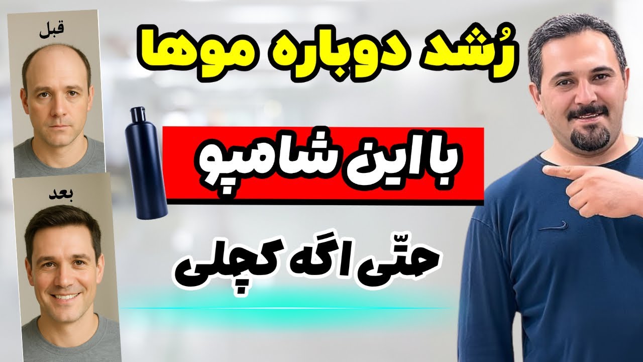 بالاخره راهش پیدا شد! 🚀 برگرداندن موهای از دست رفته فقط در چند هفته ⏳