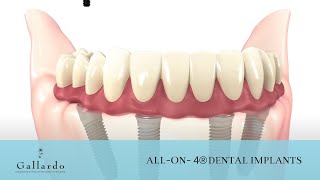 All-on-4® Dental Implants | Gallardo Periodontics and Implant Dentistry