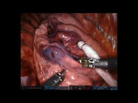 Robotic Assisted Wedge Resection for Pulmonary Nodule Using Intraoperative ICG Tattoo