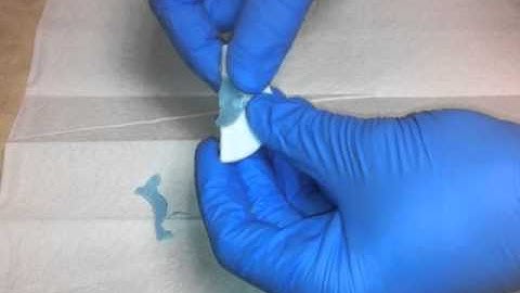 Forming the QuickSplint in Patient