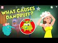 What Causes Dandruff? | How To Treat Dandruff?  | The Dr Binocs Show | Peekaboo Kidz