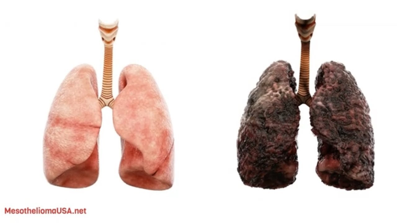 lung removal mesothelioma