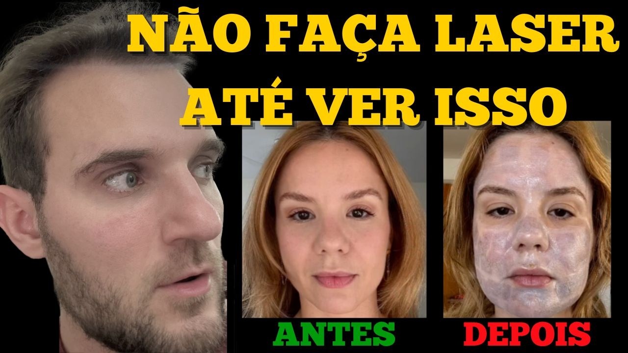 Queimou rosto com Laser CO2: veja onde foi o erro (e como evitar)