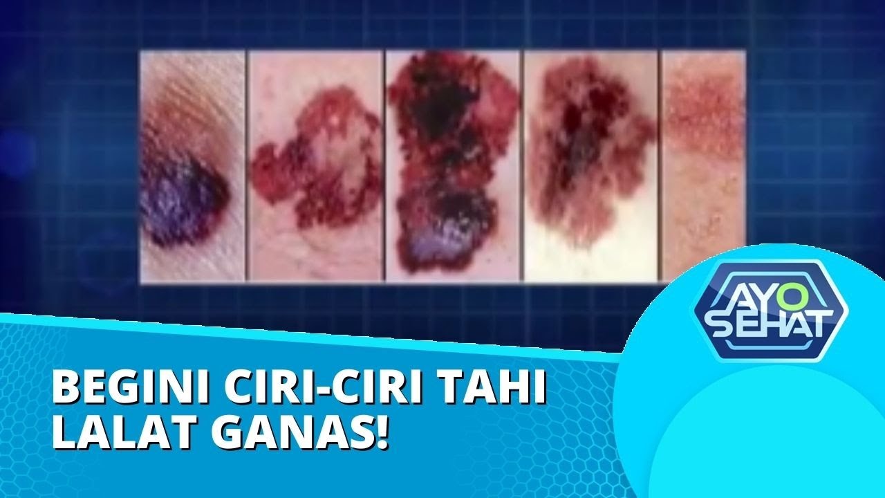 Kenali, Begini Ciri-ciri Tahi Lalat Ganas dan Melanoma