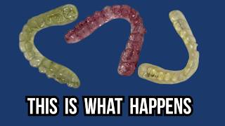 Why Your Invisalign Turns Yellow (Real Stained Aligner Collection)