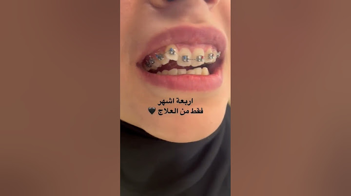 نتيجة تقويم الاسنان قبل وبعد #dr_abdullah_sultan_dentist #dentist #dental #소아치과 #anesthesia