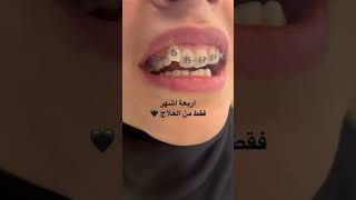 نتيجة تقويم الاسنان قبل وبعد #dr_abdullah_sultan_dentist #dentist #dental #소아치과 #anesthesia