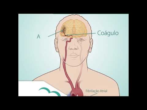 Vídeo: A cerebrovascular afeta o coração?