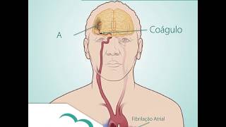 Fibrilação Atrial e AVC