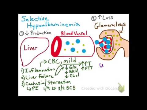 Wideo: Hipoalbuminemia: Przyczyny, Leczenie I Nie Tylko