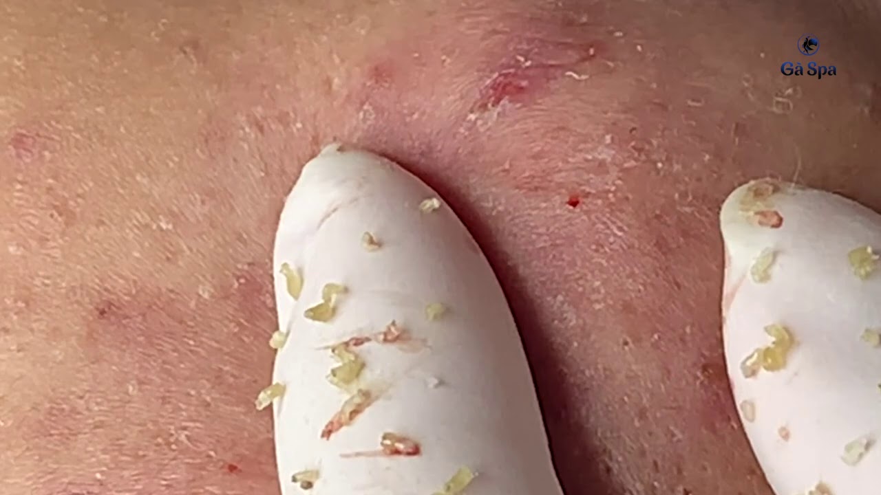 Sqeezing Hidden Acnes.
