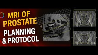 Prostate MRI Planning Tutorial | Siemens 1.5T & 3T Explained