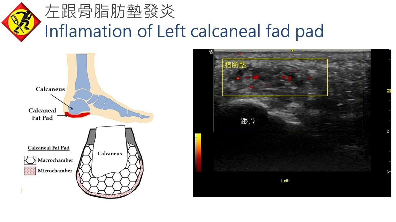 足跟脂肪墊症候群, Heel Fat Pad syndrome YouTube