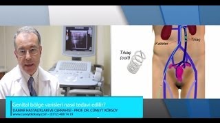 Download Prof.dr. Cüneyt Köksoy - Genital Bölge Varisleri Nasıl Tedavi Edilir? Video MP3 Prof.dr. Cüneyt Köksoy - Genital Bölge Varisleri Nasıl Tedavi Edilir?