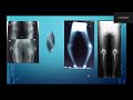 Robot as a Biomedical Device in joint replacement - Dr Mukesh Mohan, Trichy
