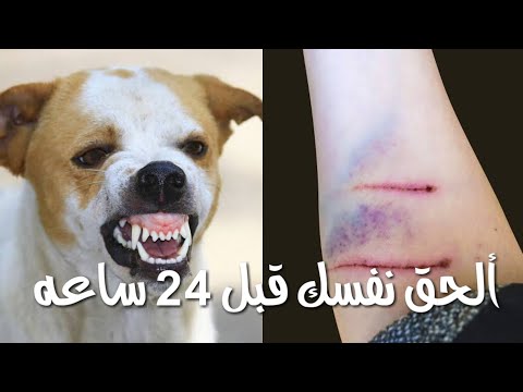 لو كلب عضك تتصرف ازاي بسرعه 